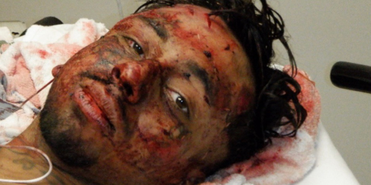 Aftermath of beating